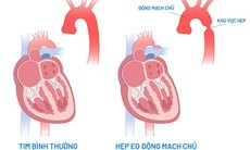 Điều trị hẹp eo động mạch chủ như thế nào?