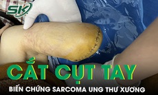 Cắt cụt tay do khối u xương xâm lấn tới hệ thống gân cơ, mạch máu, thần kinh