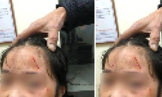 Vụ nữ sinh lớp 6 ở Hà Nội bị bạn đánh chảy máu mặt: UBND quận yêu cầu xác minh