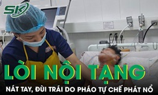 Thủng trực tràng, vỡ bàng quang, dập nát tay trái, đùi trái do pháo tự chế phát nổ