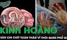 Sán len lỏi chi chít từ chân tới não vì thói quen ăn đồ tái, sống