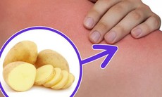 Khoai tây có tác dụng chữa bệnh gì?