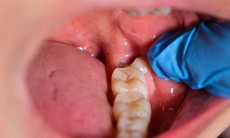 Có cần thiết phải nhổ răng khôn?