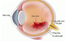 Xuất huyết dịch kính có đáng lo?