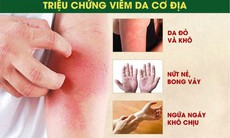 Điều trị viêm da cơ địa ai cũng cần biết