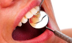 5 cách phòng viêm quanh răng tránh nguy cơ rụng răng
