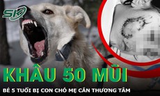 Bé 5 tuổi bị chó cắn phải khâu gần 50 mũi ở mặt