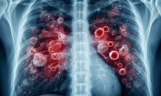 Lao phổi: Nguyên nhân, triệu chứng, đường lây truyền và cách điều trị