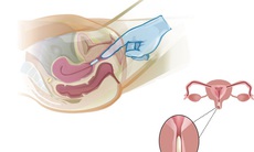 Biện pháp điều trị nấm Candida âm đạo