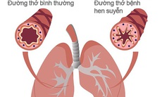 Cách mới để hạn chế các cơn hen suyễn