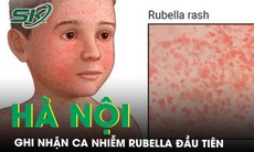 Ghi nhận ca mắc rubella đầu tiên tại Hà Nội trong năm 2024 