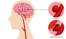 Đau đầu đột ngột coi chừng phình động mạch não