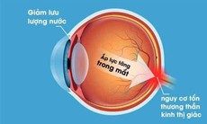 Thực phẩm tốt cho mắt và phòng ngừa tăng nhãn áp