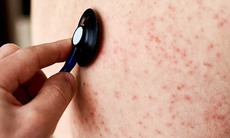 Nhiều trường hợp mắc rubella, dấu hiệu nào nhận biết bệnh sớm?