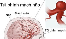 Phình mạch máu não phát hiện bằng cách nào?