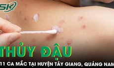 Quảng Nam ghi nhận 11 ca mắc thuỷ đậu tại huyện Tây Giang