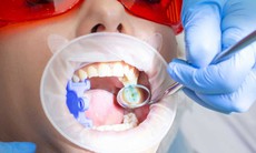 4 cách giúp răng chắc khỏe, ngừa sâu răng