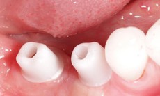 Trồng răng implant DCT - Giải pháp ăn nhai bền vững cho người mất răng