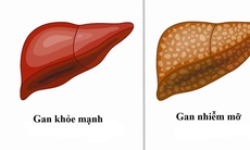 Gan nhiễm mỡ: Nguyên nhân, biểu hiện, điều trị và phòng bệnh