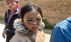 Thông tin mới vụ học sinh lớp 1 nghi bị cô giáo đánh tím mắt ở Yên Bái