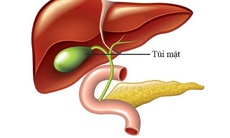 Polyp túi mật là gì? Khi nào cần điều trị?