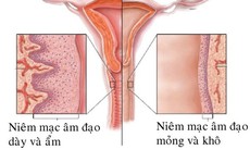 Mệt mỏi, lo lắng, căng thẳng cũng gây khô, teo âm đạo và cách cải thiện