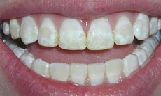 6 bệnh về răng miệng nguy hiểm cần phát hiện sớm
