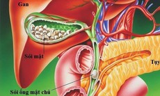 Sỏi túi mật có phải phẫu thuật không?