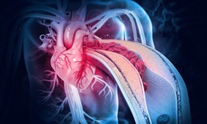 Nhồi máu cơ tim cấp: Nguyên nhân, biểu hiện, điều trị và phòng bệnh