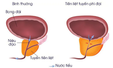 Phì đại tiền liệt tuyến: Nguyên nhân, triệu chứng, điều trị và cách phòng ngừa