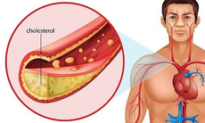 Tại sao thanh niên từ 20 tuổi trở lên nên kiểm tra cholesterol 5 năm/ lần?