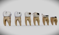 Sâu răng: Nguyên nhân, triệu chứng, điều trị và cách phòng ngừa
