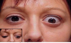 Biến chứng của bệnh Basedow và cách đối phó