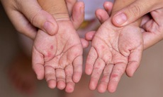 TPHCM: Tăng ca mắc tay chân miệng, giảm ca sốt xuất huyết