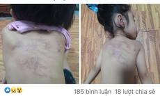 Bé gái 5 tuổi nghi bị bạo hành ở trường, Chủ tịch TP. Hải Phòng yêu cầu làm rõ