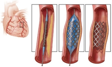 4 điều cần chú ý sau khi đặt stent động mạch vành