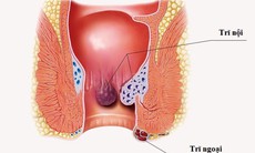 Bài tập giảm tái phát cho người bệnh trĩ