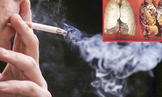 Hút thuốc lá chiếm đến 97% nguyên nhân gây ra ung thư phổi 