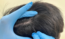 Thói quen nhổ tóc sâu, tóc bạc gây hại da đầu như thế nào?
