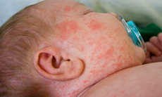 TPHCM ghi nhận 2 ca mắc bệnh sởi đầu tiên, đều chưa tiêm vaccine