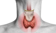 Cách điều trị và biện pháp phòng ngừa bệnh bướu giáp lan tỏa