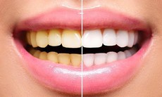 Tẩy trắng răng có hại không? Các bước tẩy trắng răng tại nhà