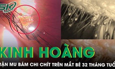 Kinh hoàng rận mu bám chi chít trên mắt bé trai 32 tháng tuổi 