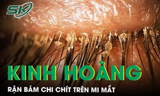 Kinh hoàng bé 5 tuổi bị rận bám chi chít trên mi mắt