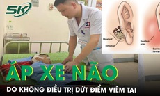 Nguy kịch vì không điều trị dứt điểm viêm tai dẫn tới biến chứng áp xe não