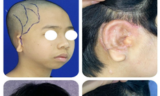 Bé trai 5 tuổi dị tật lép nửa mặt, tai nhỏ được 'trả lại' gương mặt cân đối