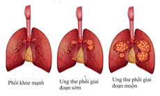 Các lựa chọn điều trị ung thư phổi