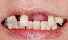 Rụng răng ở người già có phòng ngừa được không?