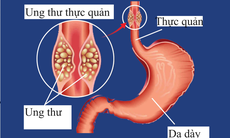 Các loại thuốc điều trị ung thư thực quản