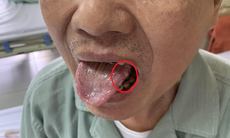 Ung thư khoang miệng: Nguyên nhân, triệu chứng, phòng ngừa và điều trị